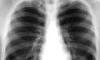 Increasing popularity of new drug-resistant TB strains