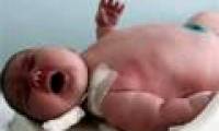 Infant weight is related to autism