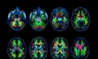 Internet addiction harms the brain