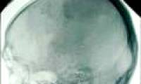 Is the body still alive after brain death?