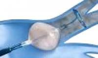 Israel, America cures breast cancer without cutting