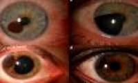 It turns out that the iris may also have cancer, and what happens afterwards will startle you