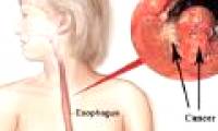 Japan announced a new method of treating esophageal cancer