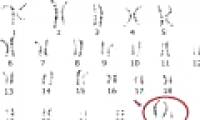 Klinefelter Syndrome - Men carry the female gene