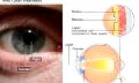 Laser light prevents disease due to retinal degeneration