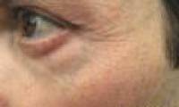 LEDs can slow the rate of skin aging