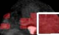 Magnetic resonance imaging finds prostate cancer