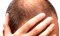 Men with baldness are at risk for coronary artery disease