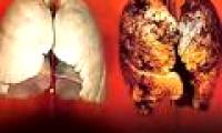 Metformin can prevent lung cancer