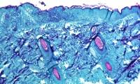 Monkeypox: Causes, symptoms and treatment