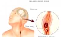 New hope for patients with stroke