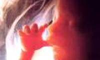New measures to diagnose Down syndrome in the fetus
