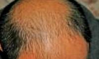 New method of treating baldness