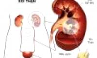 New method to diagnose membrane glomerular disease