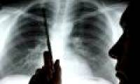 New radiotherapy for lung cancer patients