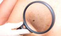 New technology on 6G phones can help detect skin cancer early