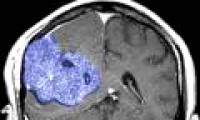 New therapy, effective in cancer treatment