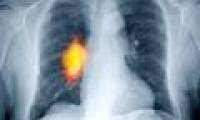 Non-smokers still have lung cancer