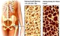 Osteoporosis - The disease is silent