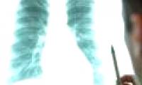 Patients with lung cancer metastasize throughout the body still cured