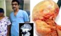 Petrified fetuses lay 15 years in the 52-year-old woman's belly