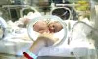 Preterm birth changes a child's brain connection