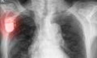 Prevent implant attacks