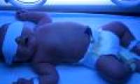 Preventing jaundice in newborns