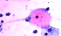 Prostate cancer may be sexually transmitted