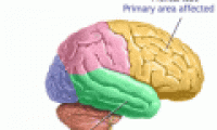 Protein against Alzheimer's disease?