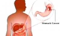 Protein discovered to prevent stomach cancer from spreading