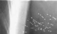 Radioactive particles can treat the root of breast cancer