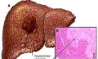 Relationship between hepatitis B and lymphoma