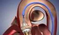 Russia successfully assembled the latest artificial heart valve model