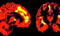 Sad memories change the amount of gray matter in the brain