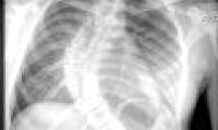 Schoolgirl has a 90 degree scoliosis