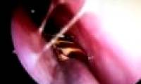 Severe shock when detecting cockroaches living in the skull