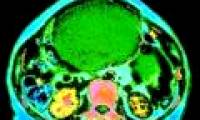 Signs of ovarian cancer are often confused