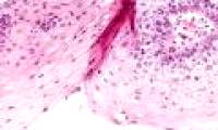 Signs of warts and treatment