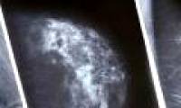 Similarities between breast and ovarian cancer