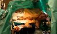Singer comfortably sings opera during brain tumor surgery