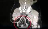 Sitting in the toilet for too long, the man's organs fell out
