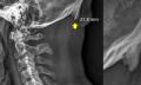 Skull 'sprouting' spikes suspected by smartphone addiction
