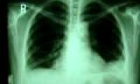 Smoking can reduce life expectancy by 15 years