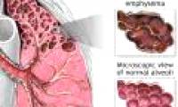 Stem cell therapy will help restore lung tissue