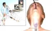 Successful recovery of the trachea of ​​people with cancer