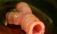 Successfully implanted artificial trachea made from stem cells