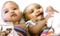 Successfully separated conjoined twins