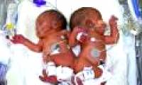 Successfully separated twins sticking to the spine