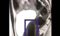 Successfully transplanted artificial vagina for women